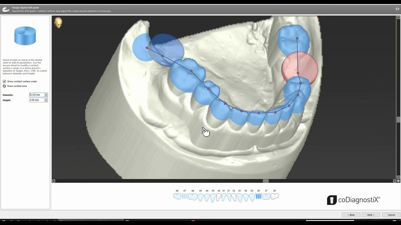 Bohrschablonen schnell und einfach designt mit Dental Wings coDiagnostiX