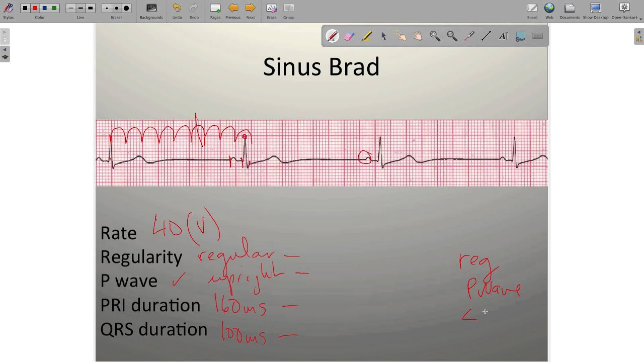 ECG Sinus Rhythms