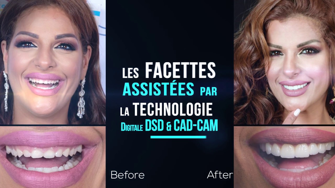 New Smile Casablanca / Elite Smile Academy / Dr Amina EL OMRANI / Facettes dentaires