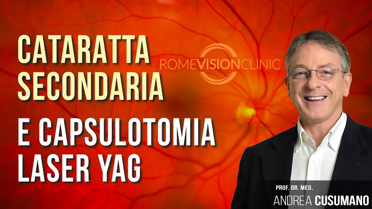 Cataratta secondaria e capsulotomia laser YAG