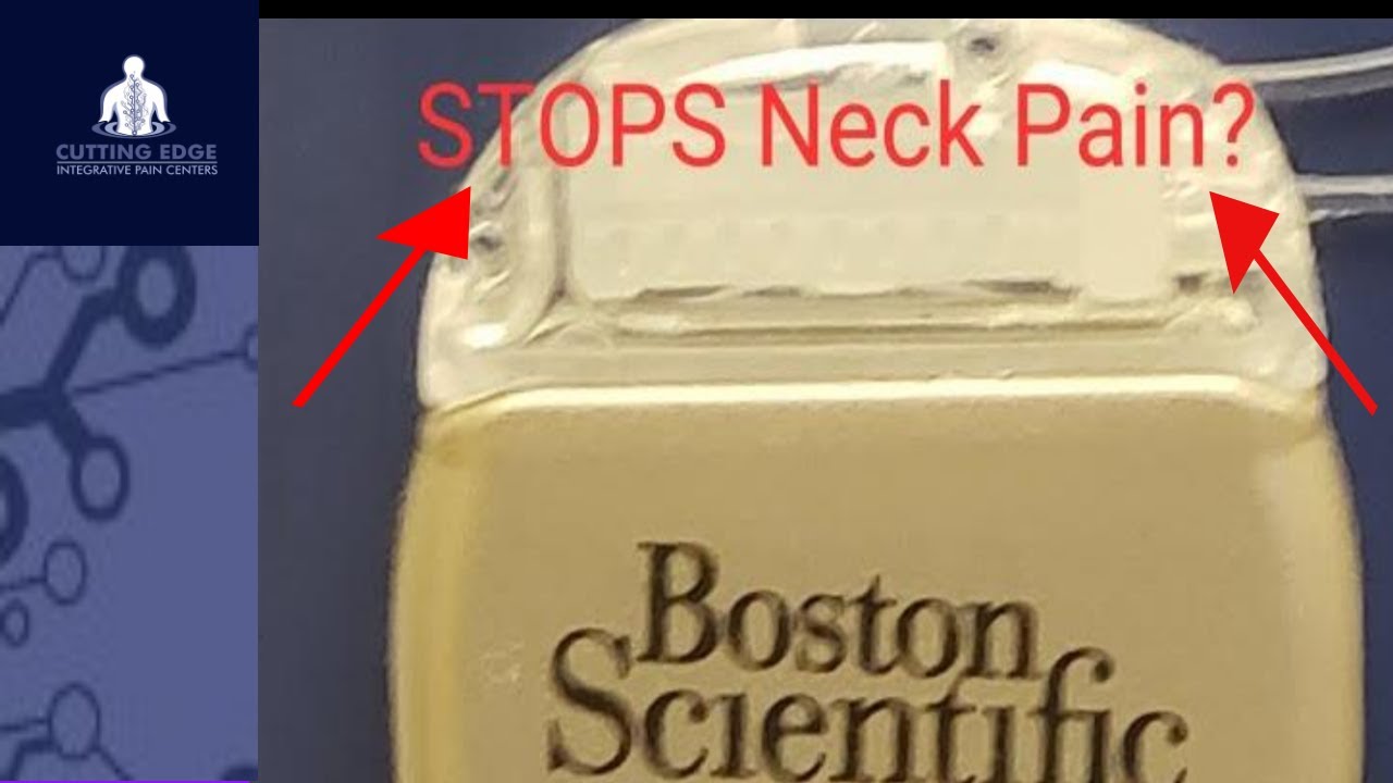 Spinal Cord Stimulation: Can it Stop Neck Pain?