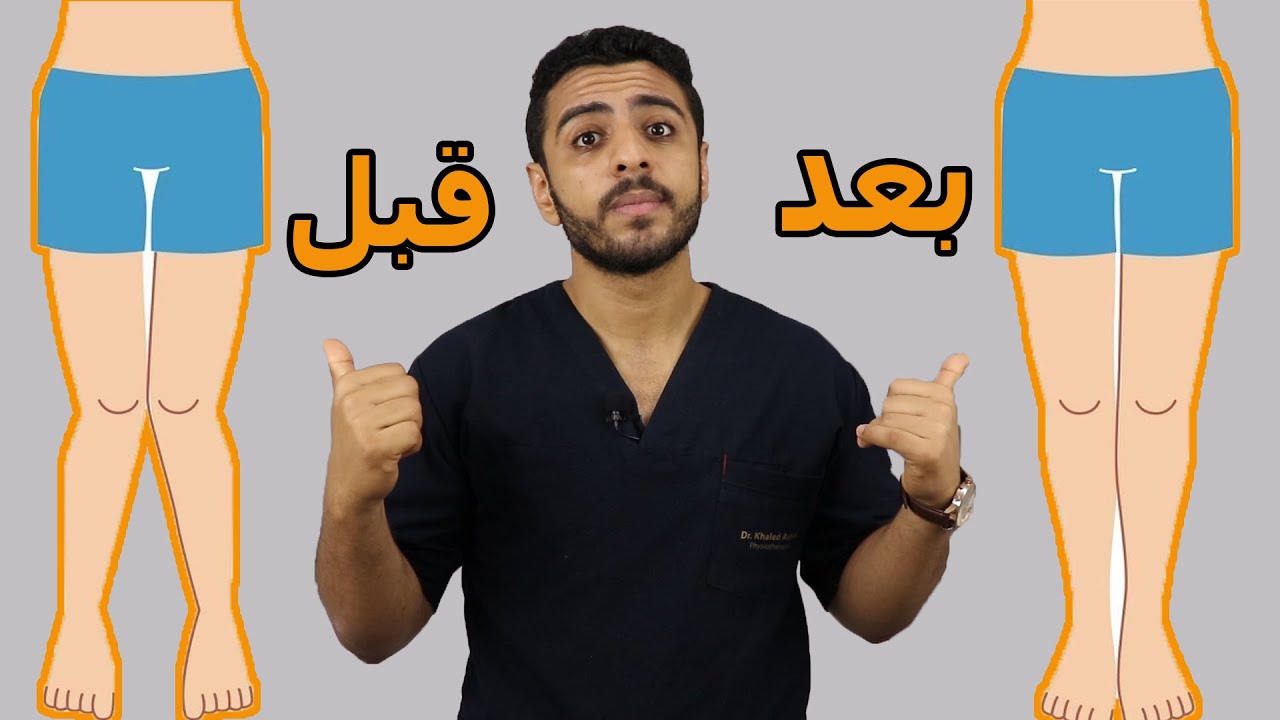 علاج تقوس الساقين للداخل والتصاق الفخذين /تقوس الركبه للداخل فى 2020(knock knee)