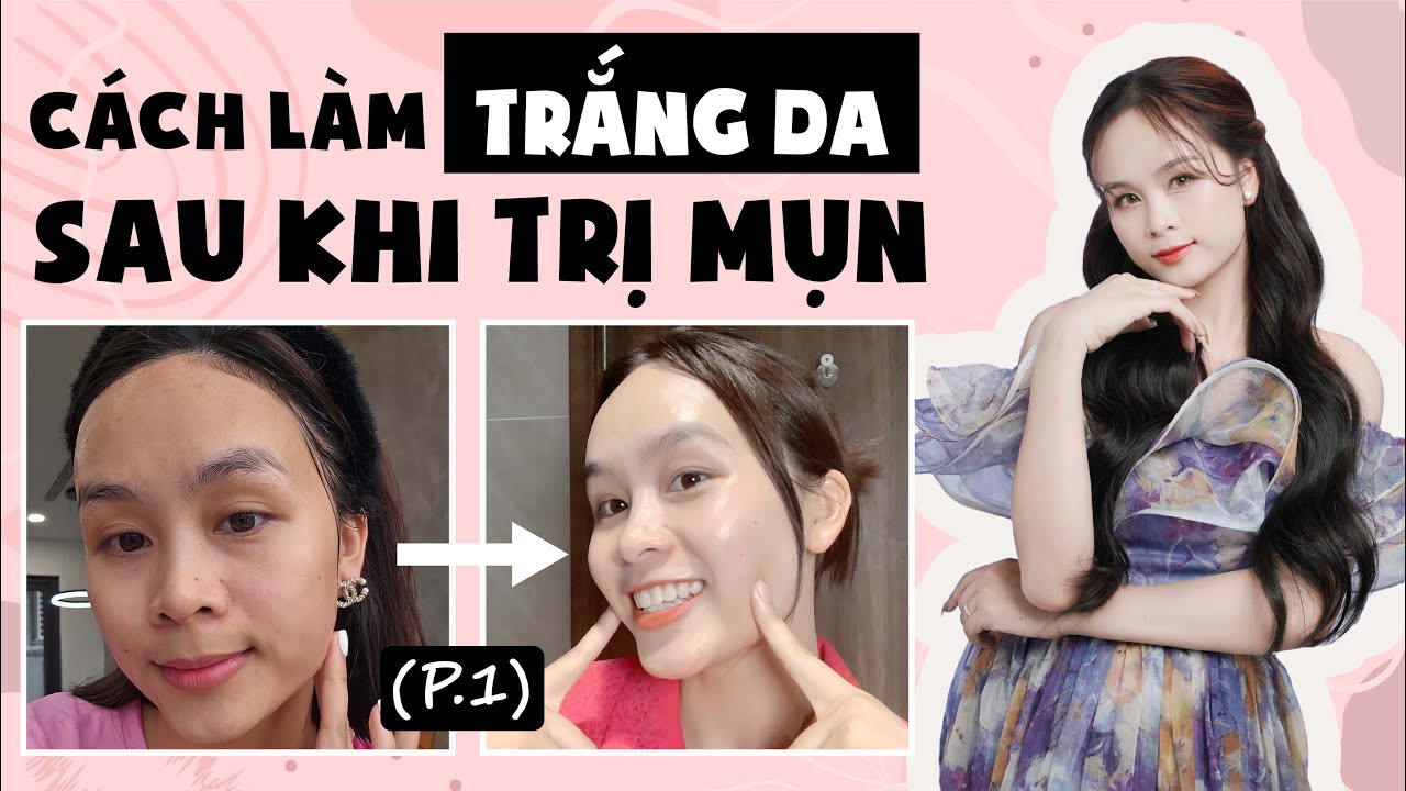 Bật mí CÁCH LÀM TRẮNG DA TỰ NHIÊN tại nhà sau khi TRỊ MỤN (P.1) | Hoàng Ngoan Beauty