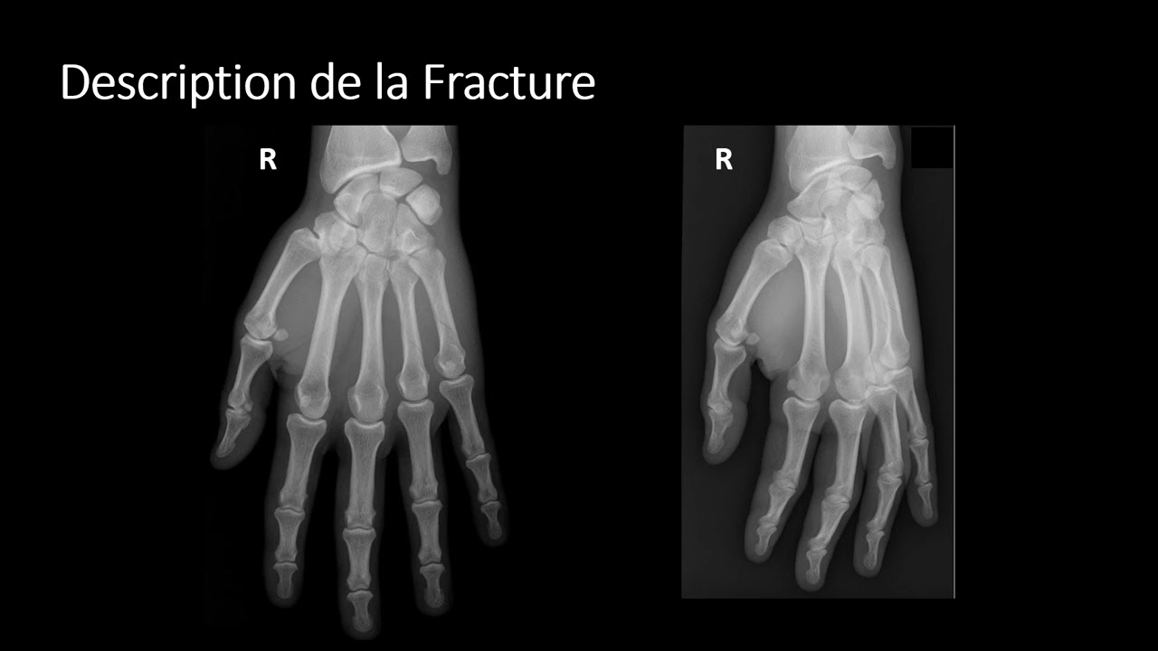 Description des fractures - français2