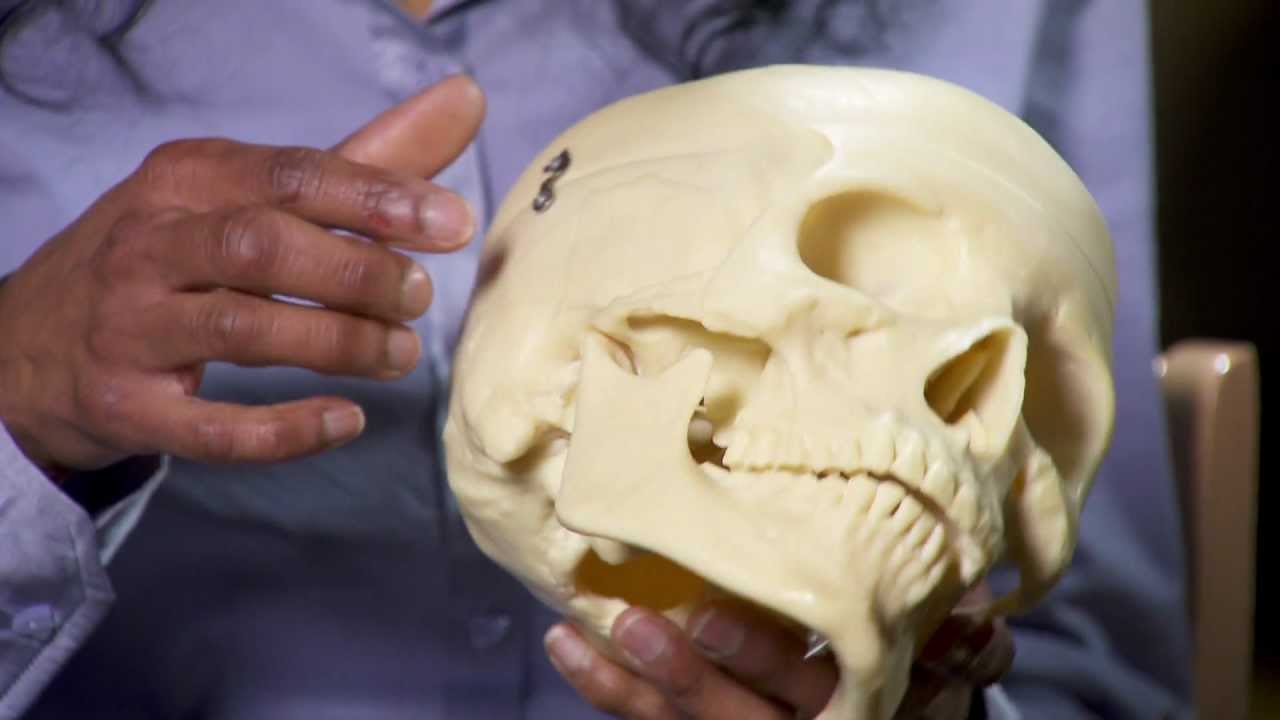 Craniotomy