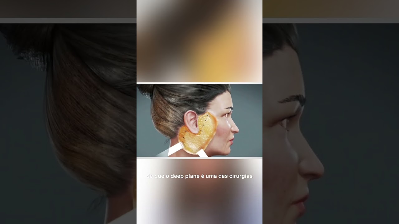 Como &eacute; feito o LIFTING FACIAL