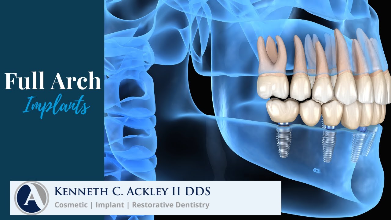 Full Arch Implant Restoration Can Replace Multiple Missing Teeth