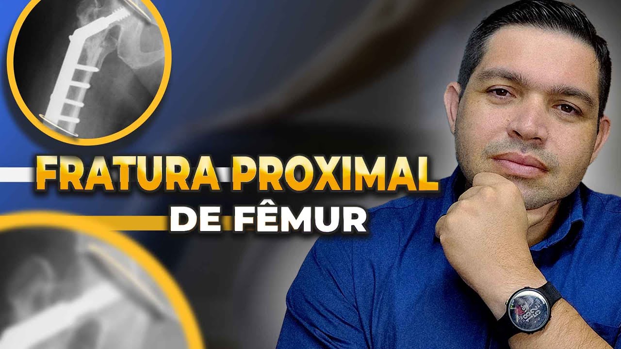 FRATURA DE F&Ecirc;MUR: O QUE NINGU&Eacute;M TE FALOU