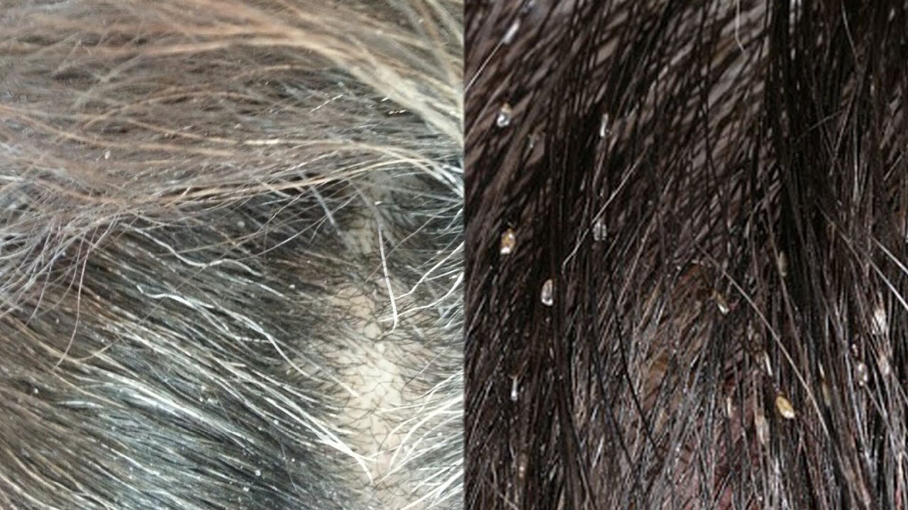 How can I tell if I have head lice or dandruff?