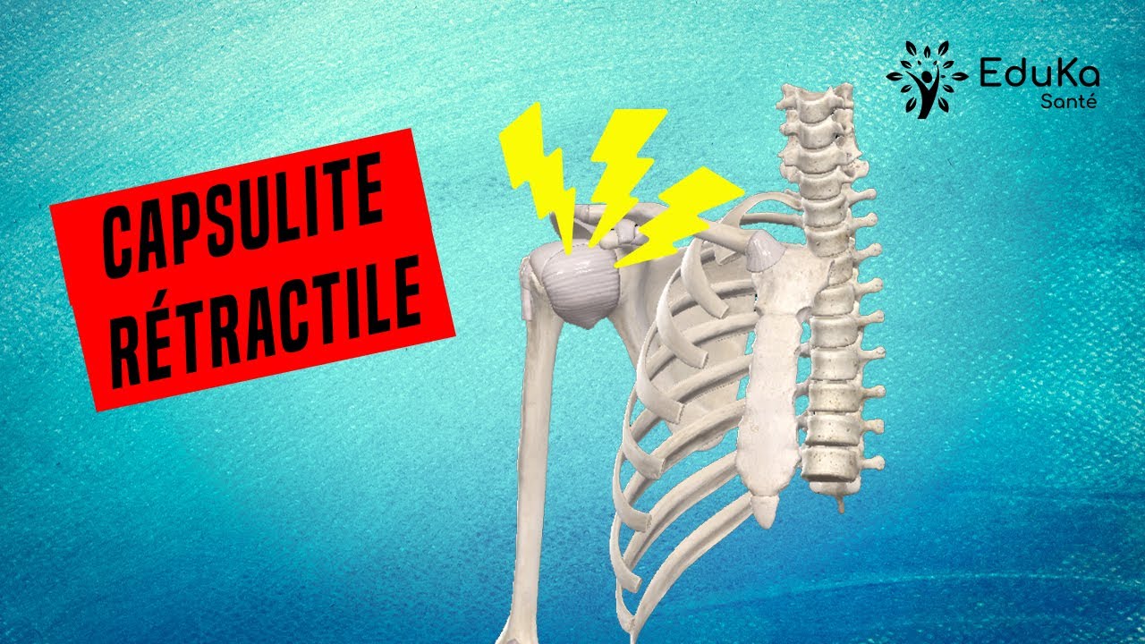SOIGNER LA CAPSULITE RETRACTILE : EXPLICATIONS ET EXERCICES