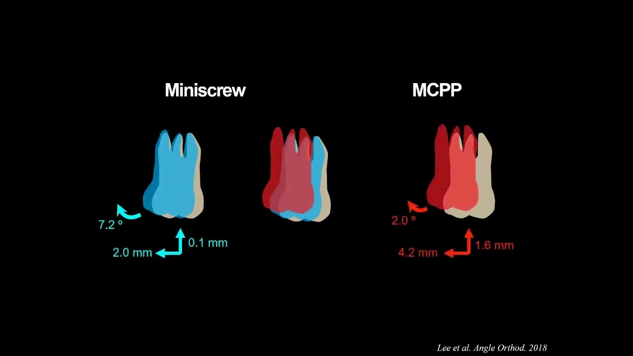 Yoon Ah Kook - Efficient Non-Extraction Approach to Correct Class II Malocclusion