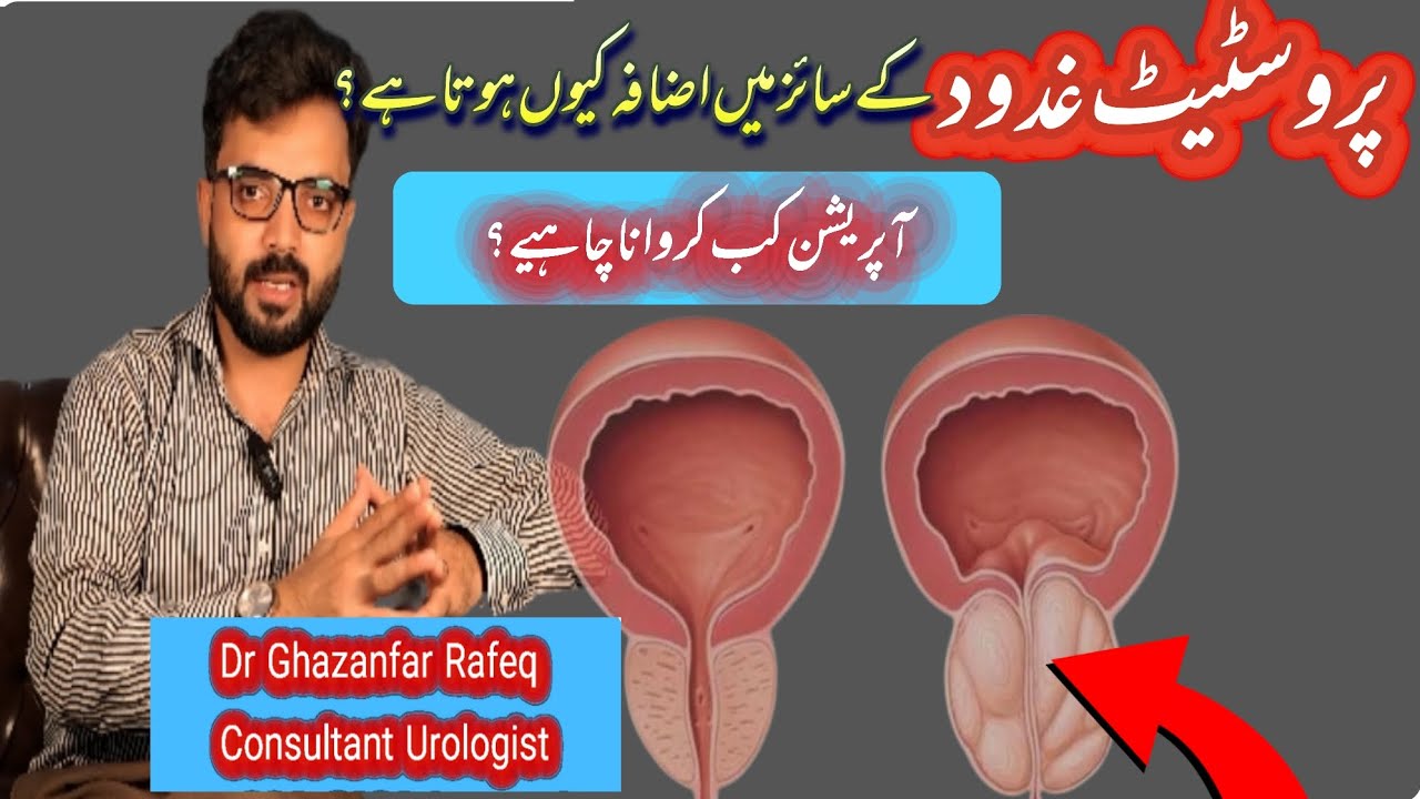 Do you have these symptoms ❓️! Prostate gland | BPH | Dr Ghazanfar Rafeq 