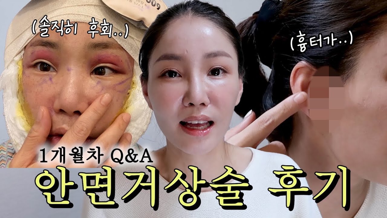 안면거상술 후기 1개월차 솔직 Q&A 다 말해드려요!!! (비용, 통증, 병원, 흉터,붓기,후회하는점..?)