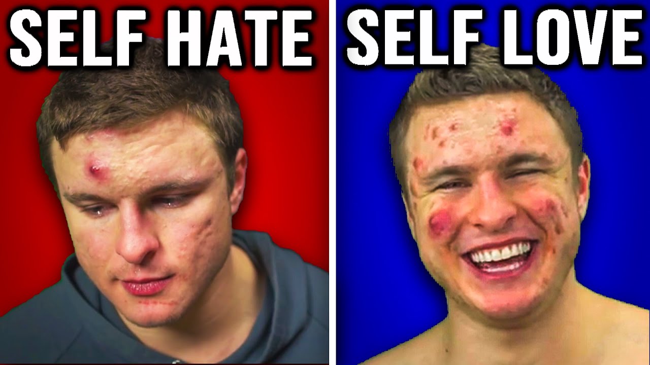Acne & Self Esteem: MY BIGGEST CONFIDENCE SECRET