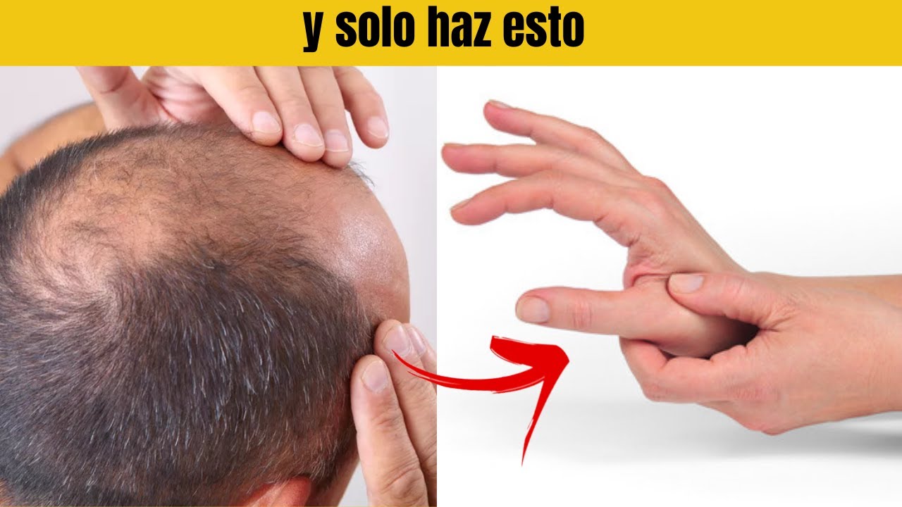 como evitar la calvicie en hombres jovenes como evitar la calvicie en hombres