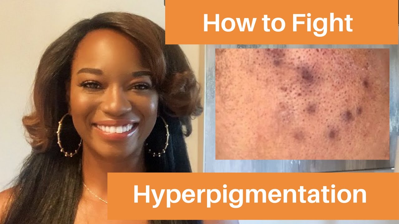 HOW TO: FIGHT HYPERPIGMENTATION with VITAMIN C | FADE DARK SPOTS FAST | Topical Tuesday Seankbeauty