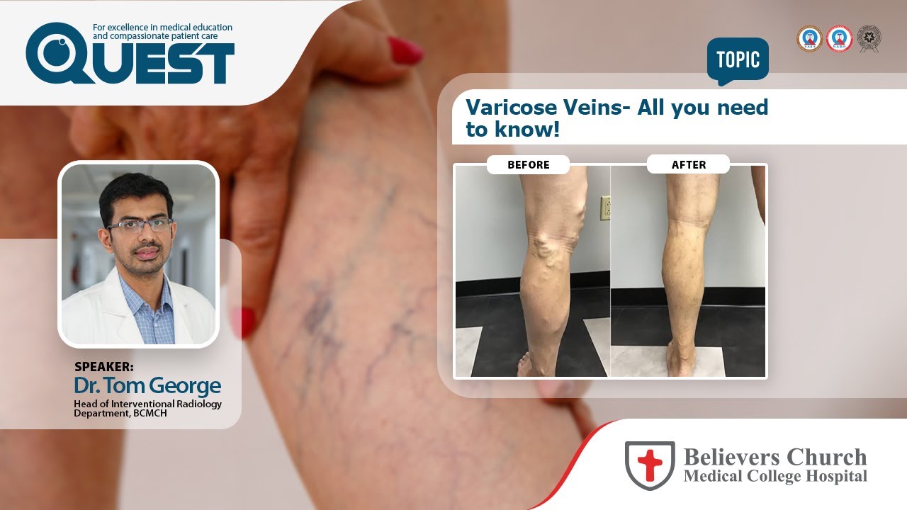 Varicose Veins - All you need to know!