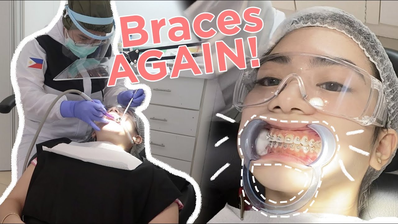I GOT BRACES AGAIN!!! 😩 (Philippines) | Jewel Mesina