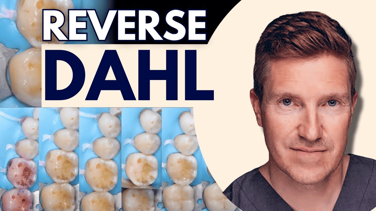 Reverse Dahl Technique for Localised Posterior Tooth Surface Loss - PDP235