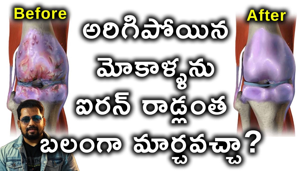 అరిగిపోయిన మోకాళ్ళను ఐరన్ రాడ్లంత బలంగా మార్చవచ్చా? Can We Reverse Osteoarthritis?