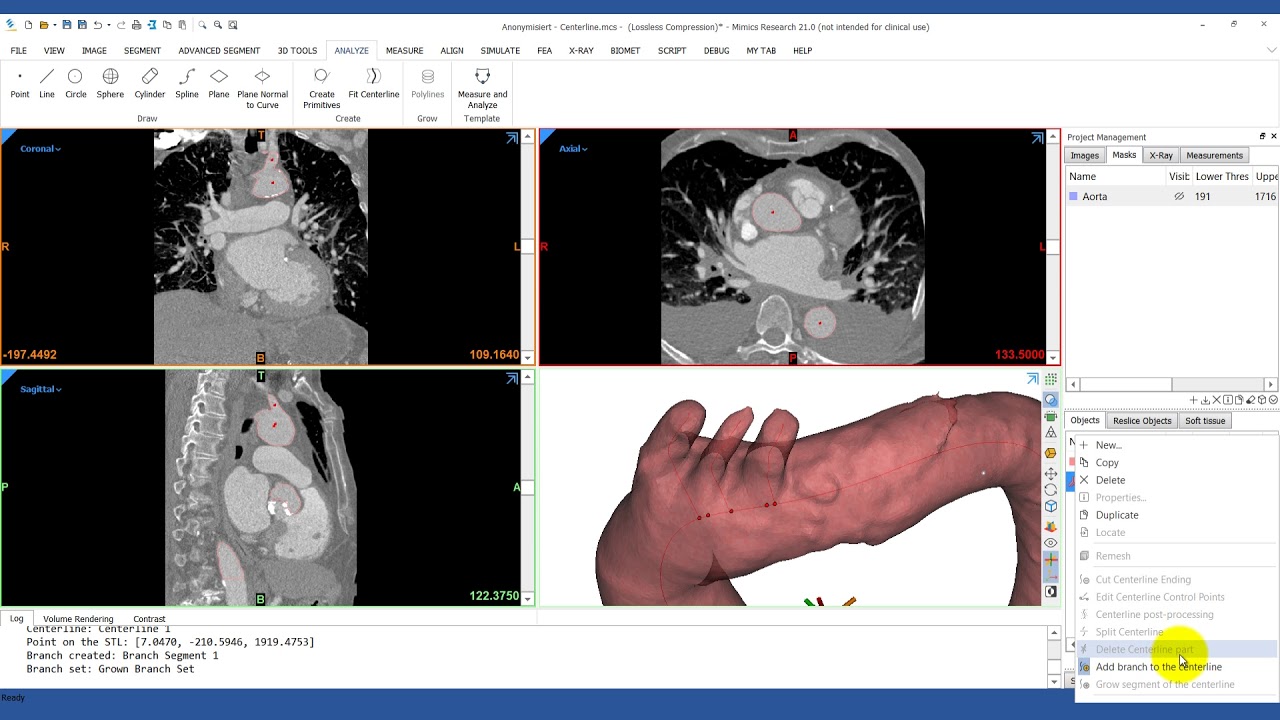 How to Analyze the Centerline of the Aorta | Mimics Innovation Suite | Materialise Medical