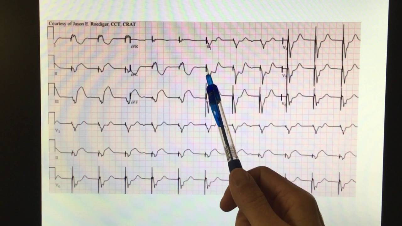 Brugada & Sgarbossa EKG