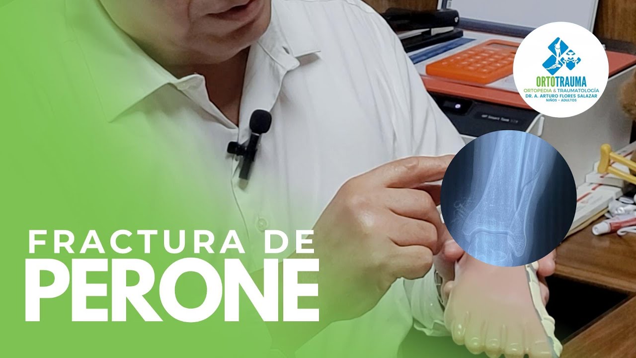 Fractura de Peroné - Caso Real
