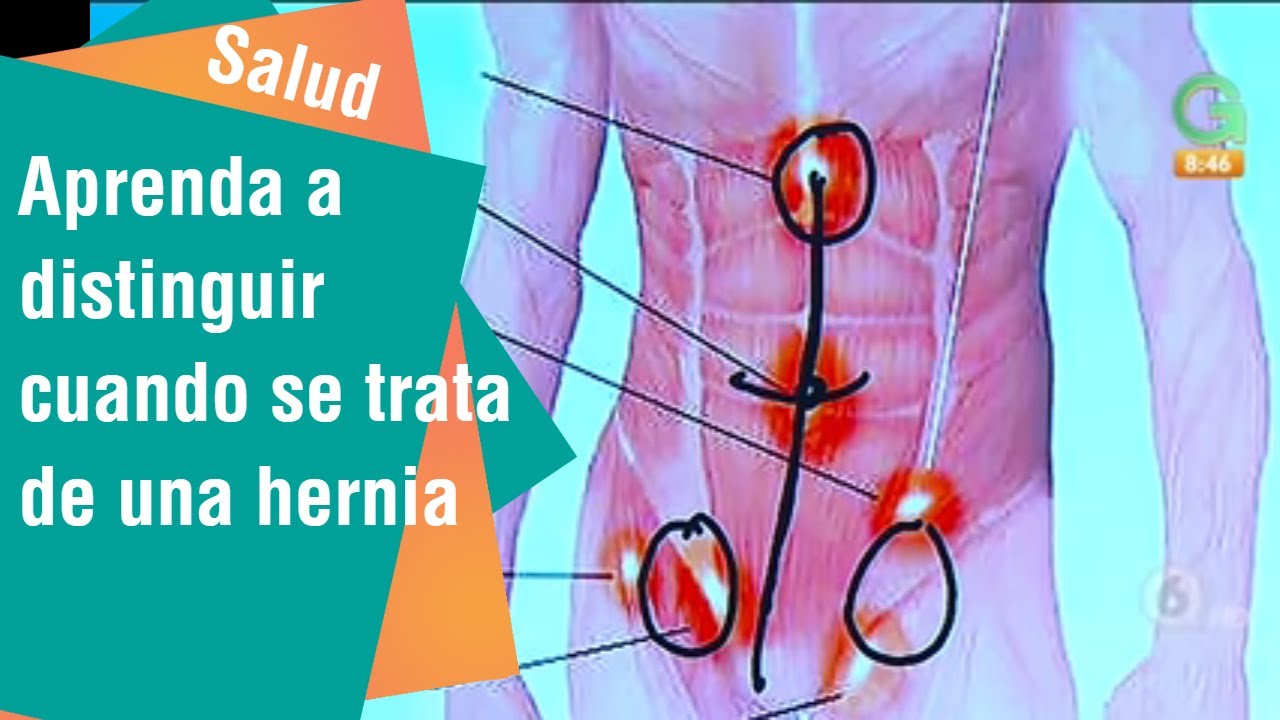 Aprenda a distinguir cuando esos bultitos en el est&oacute;mago son hernias | Salud