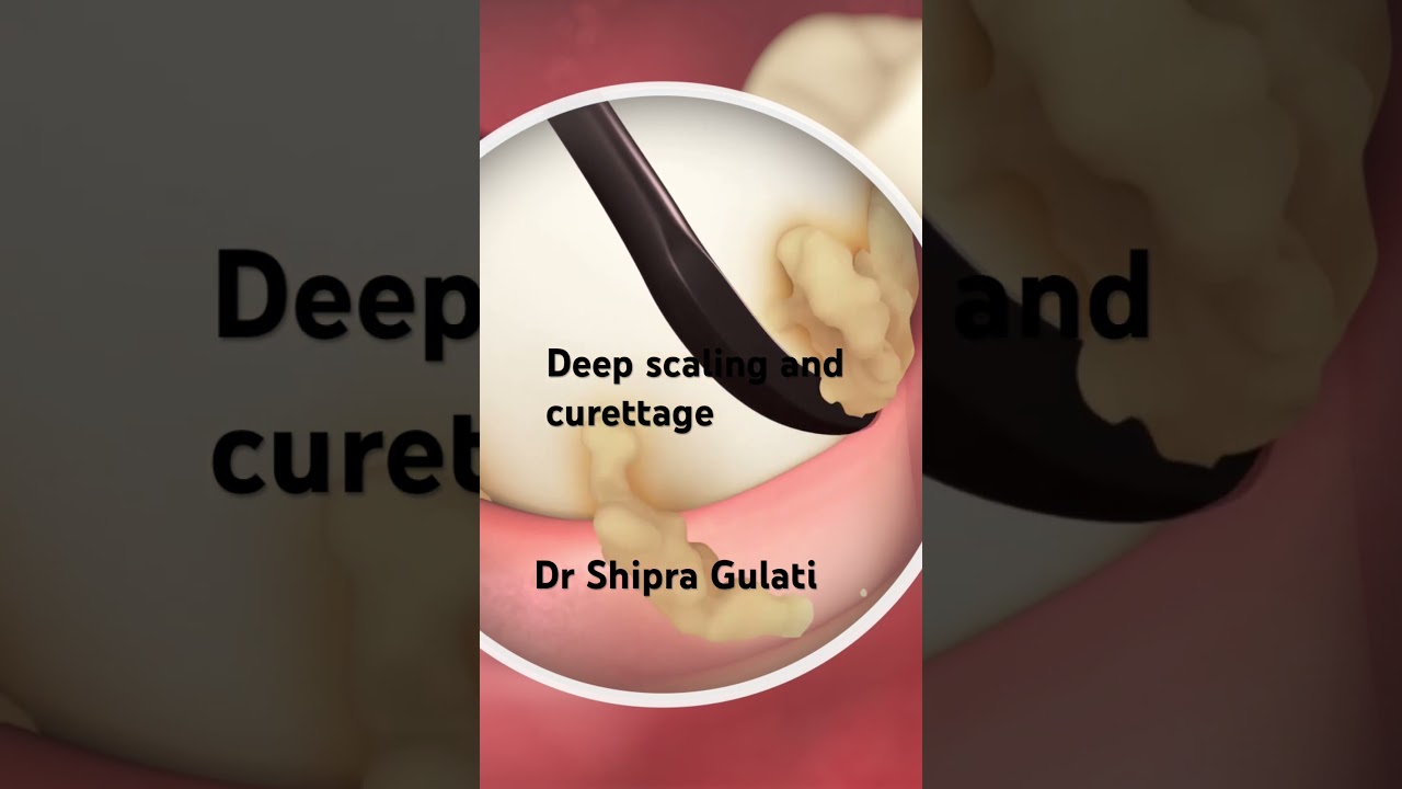 Tooth cleaning:  Scaling and curettage