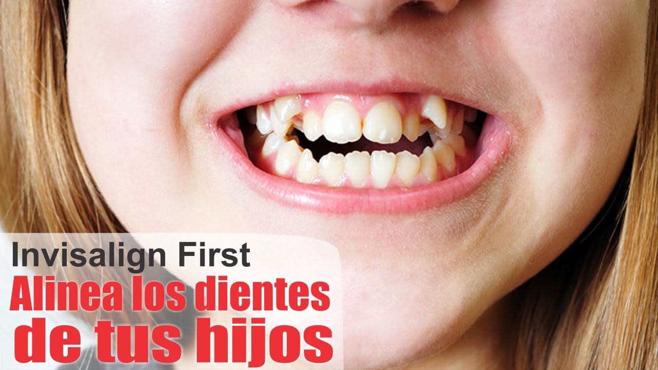 INVISALIGN First 👶 Ortodoncia INVISIBLE en NIÑOS (CASO REAL) 🚸 SANTIAGO BURGA 3D Digital Dental D