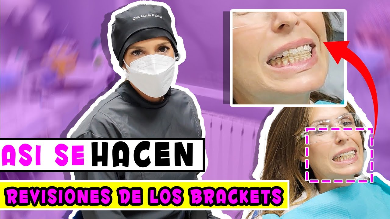 [🔴 En Vivo ] Proceso de AJUSTE DE BRACKETS 👉¿Qué te hacen en la REVISIÓN de ORTODONCIA?