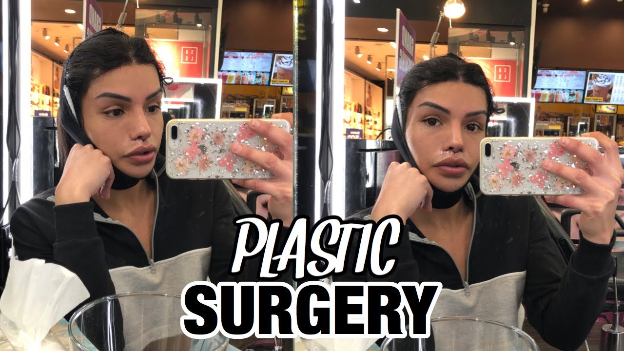 My Facial Feminization Surgery with Dr. peter raphael