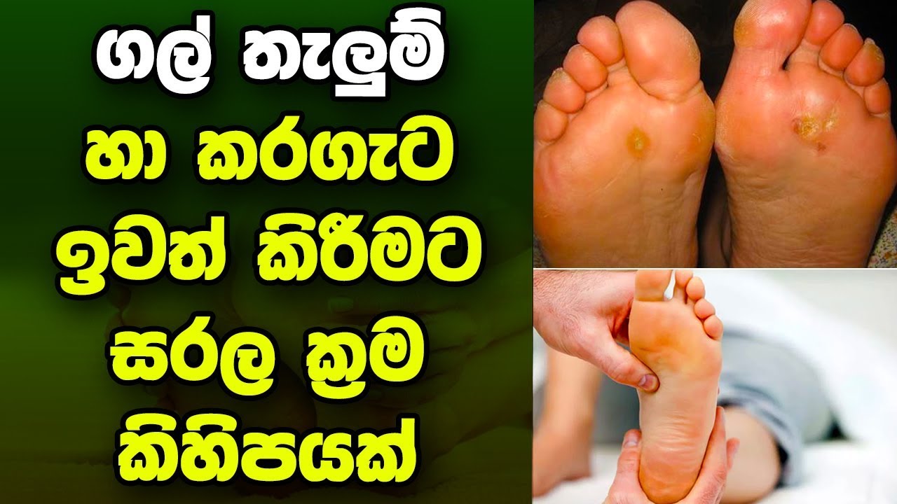 ගල් තැලුම් හා කරගැට ඉවත් කිරීමට සරල ක්&zwj;රම කිහිපයක්