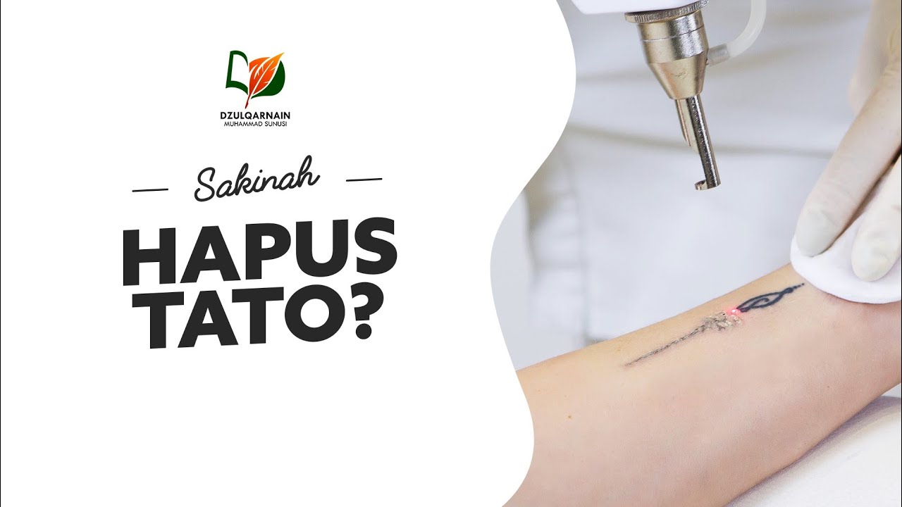 Hukum Menghapus Tato