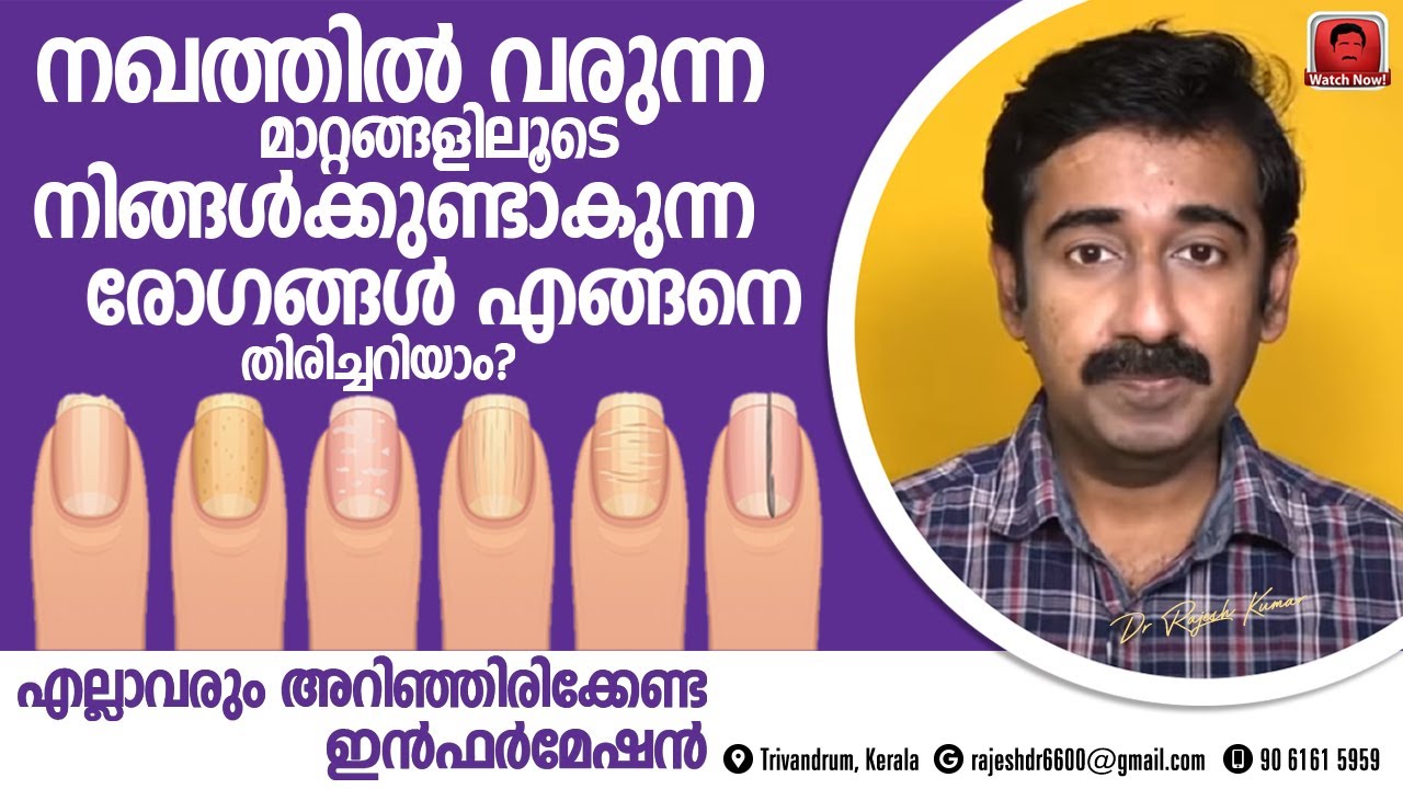 നഖത്തിൽ വരുന്ന മാറ്റങ്ങൾ നോക്കി രോഗങ്ങളെ എങ്ങനെ സ്വയം തിരിച്ചറിയാം ?  അറിഞ്ഞിരിക്കേണ്ട ഇൻഫർമേഷൻ