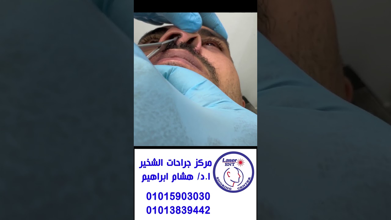 فيديو عن كيفية ازالة الدعامة عن قرب  مع ا. د. هشام ابراهيم   #مركز_جراحات_الشخير_د_هشام_ابراهيم