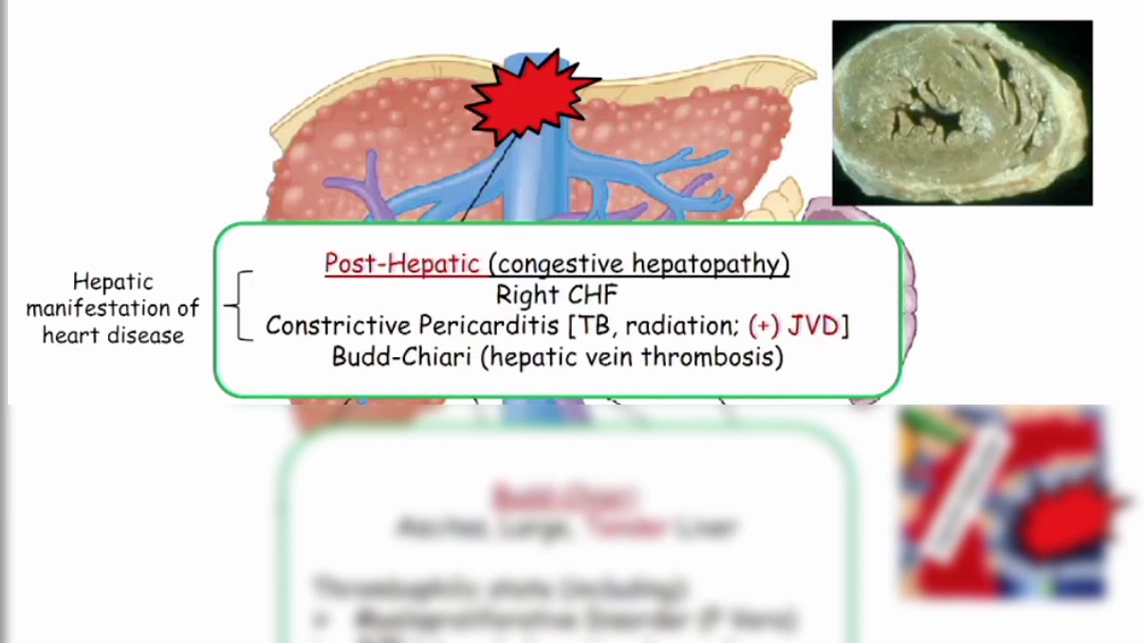 12DaysinMarch, Podcast Series, Portal Hypertension for the USMLE Step One Exam