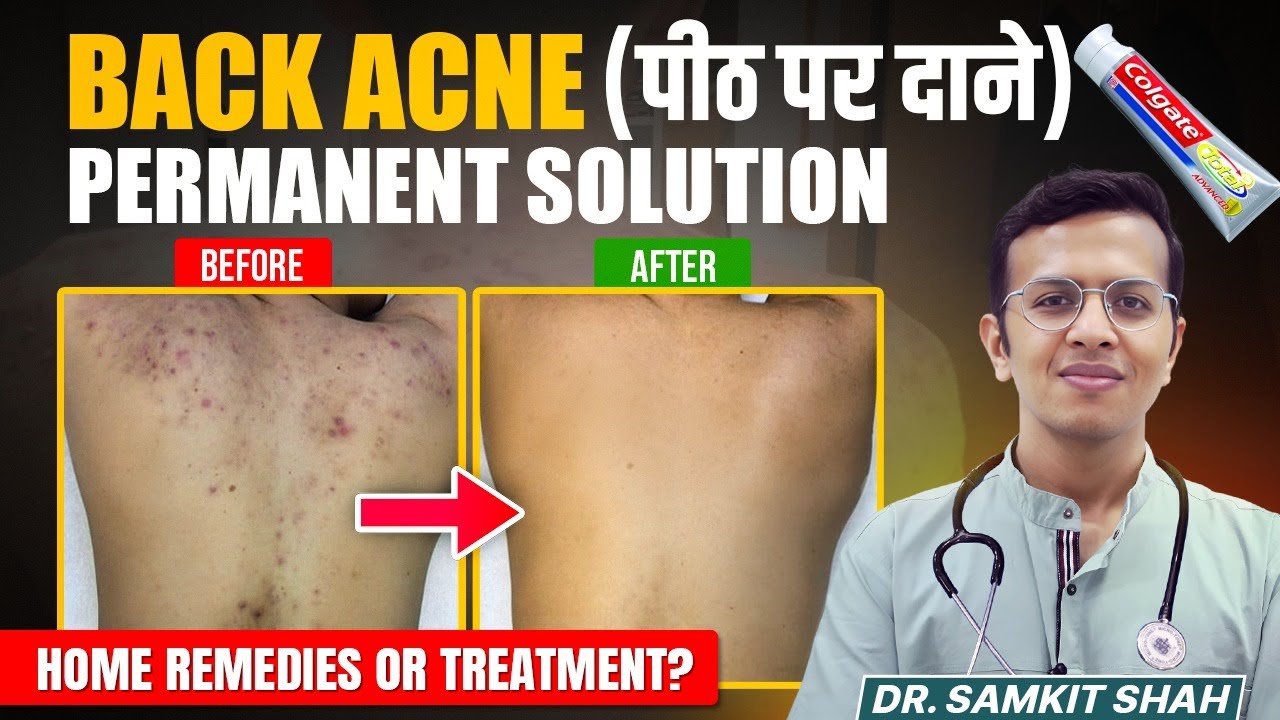 BACK Acne Treatment That REALLY Works