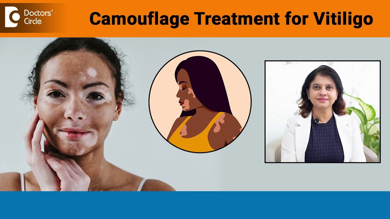 NEW VITILIGO TREATMENT|Camouflage Treatment for Vitiligo| Skin Colour-Dr.Amee Daxini|Doctors' Circle