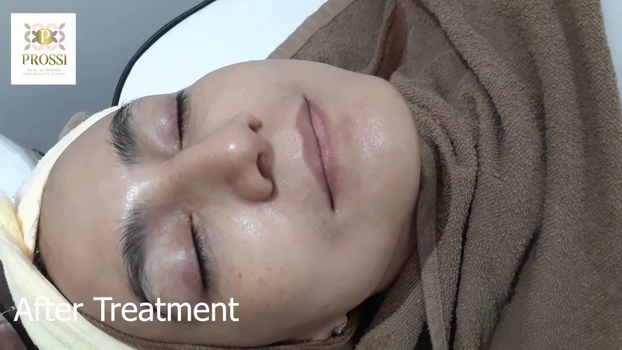 Treatment Prossi Clinic with Wanda Hamida