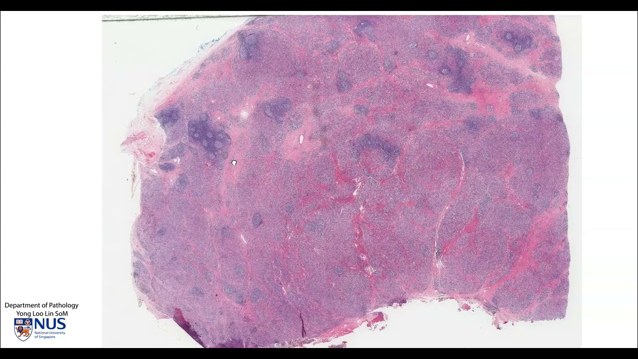 Thyroid: Hashimoto thyroiditis Microscopy - Talking slide