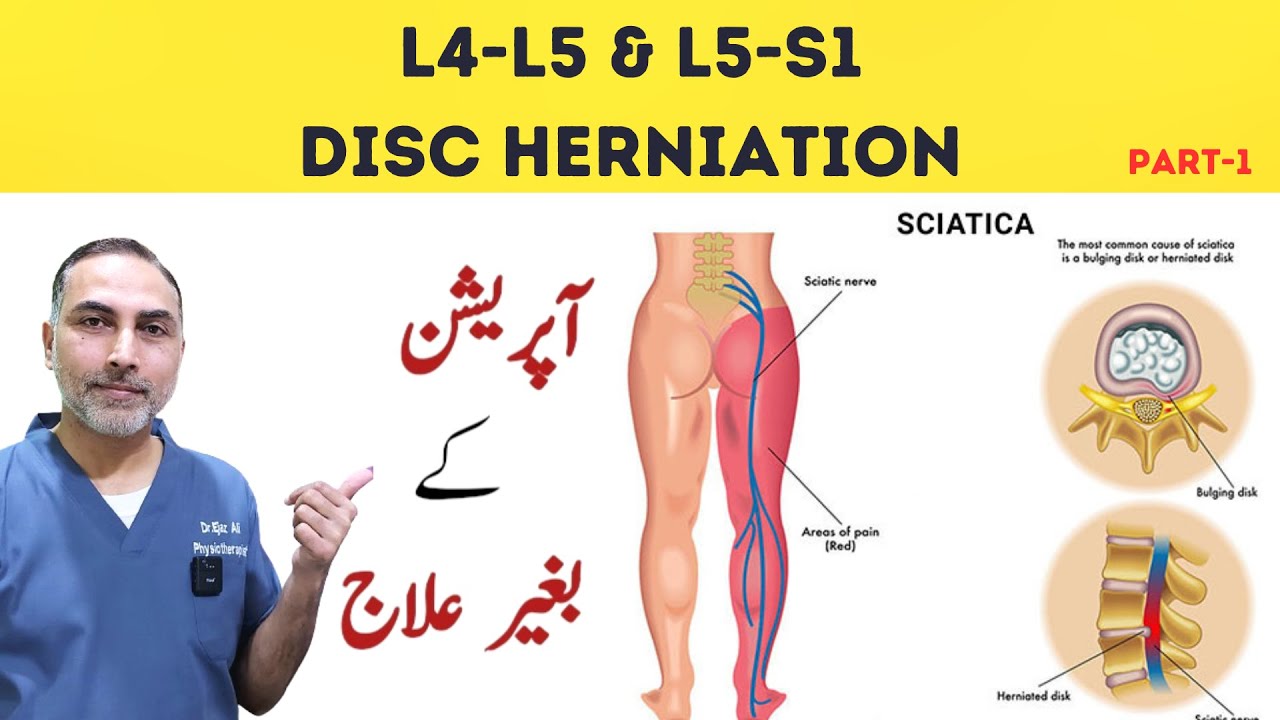 L4 - L5 and L5- S1 Disc Herniation Treatment | Slip Disc Treatment At Home #sciatica