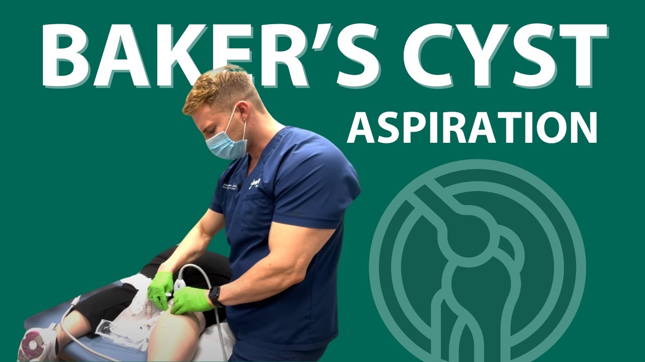 Baker's Cyst Treatment