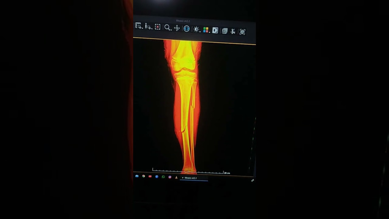 #chemistry Fracture #fracture Tibia Fibula Fracture medially