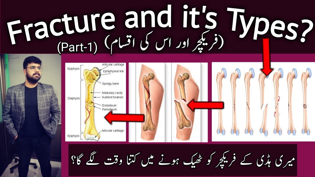 Fracture and Its Types? II فریکچر اور اس کی اقسام || A simple and Easy Guide ||