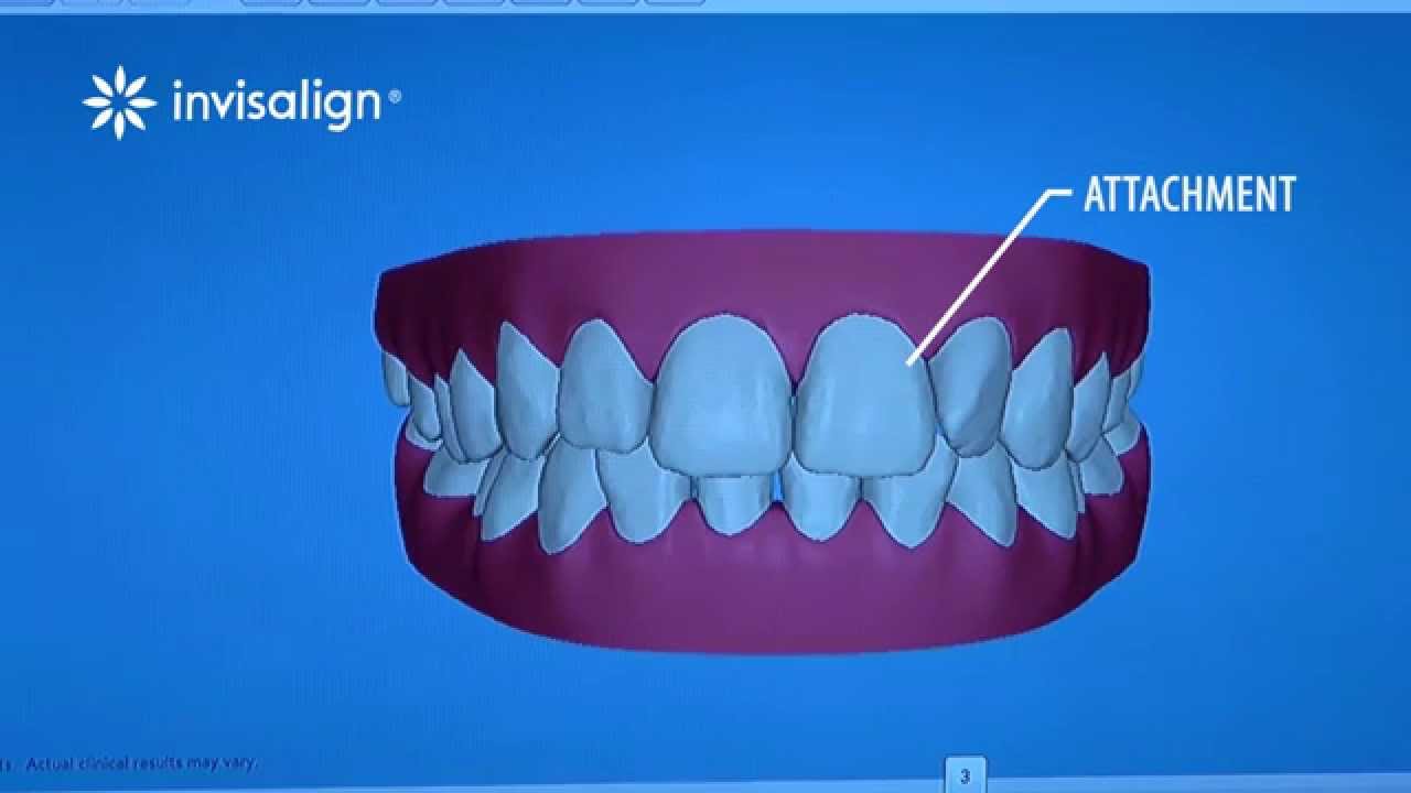 What You Can Expect During Invisalign Treatment