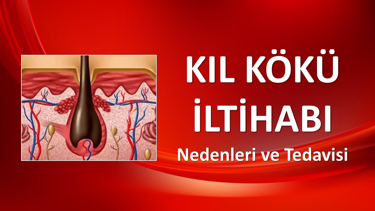 KIL KÖKÜ İLTİHABI Nedenleri ve Tedavisi