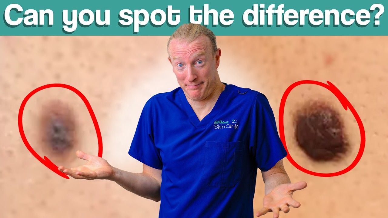 2 Melanoma cases: Why a Simple Skin Check Could Become a Lifesaver!