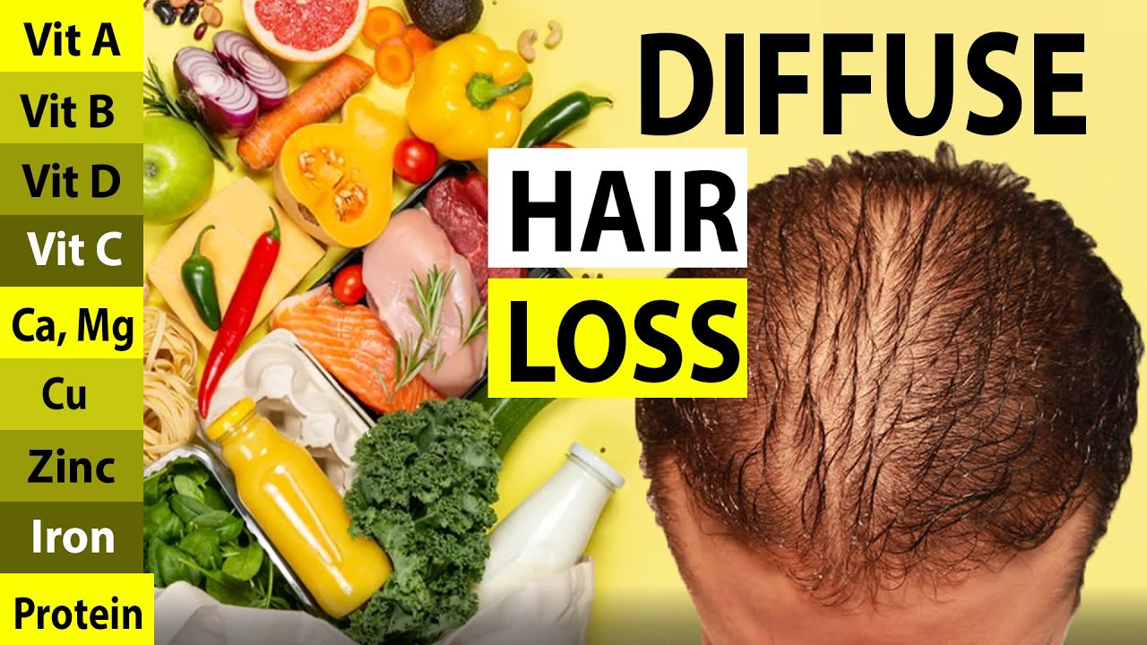 Nutritional Deficiencies Linked to Diffuse Hair Loss! Evidence Based vs Myths!