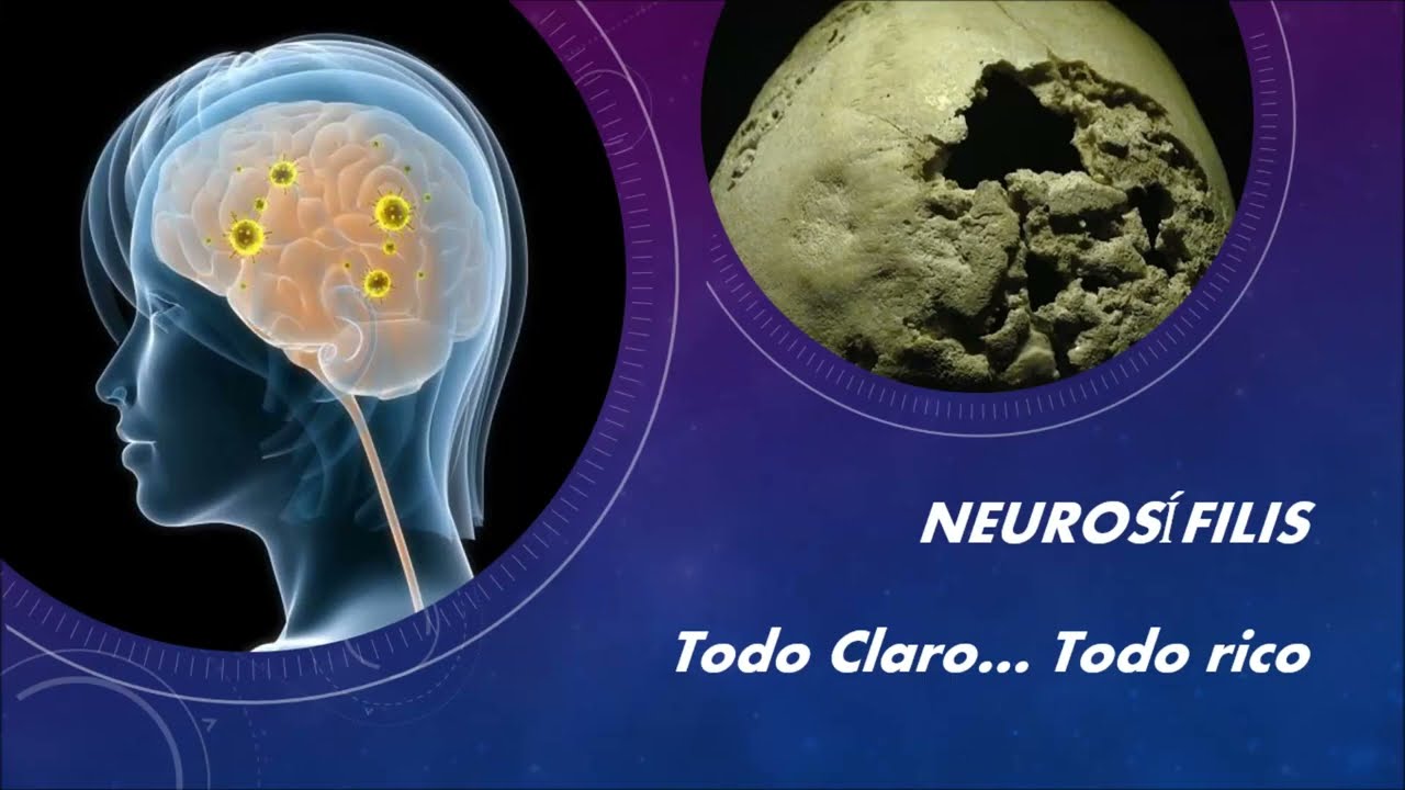 Neurosifilis: Todo claro, todo rico